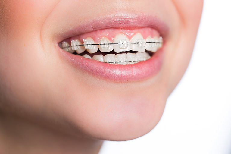 矯正歯科　～矯正相談は無料！美しい歯並びで、より健康に～